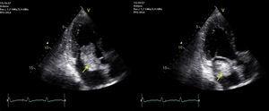 Ecocardiograma transtorácico con visión apical de 3 cámaras: se muestra tumoración a nivel de la aurícula izquierda, en diástole (izquierda) y en sístole (derecha).
