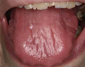 Lengua brillante y depapilada, debido a la hiposialia, en un paciente con SSp. Obsérvese también la presencia de un papiloma en el dorso lingual, así como la fractura de los bordes incisales de los dientes superiores.