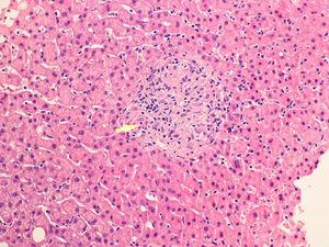 Biopsia hepática. Granuloma lobulillar no necrosante (flecha) en el seno de parénquima hepático sin alteraciones de su arquitectura.