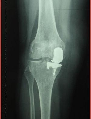 Radiografía anteroposterior de la rodilla derecha, prótesis unicameral.