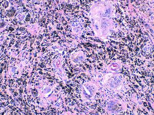 Biopsia sinovial: macrófagos cargados de pigmentos metálicos e infiltrado linfocitario.