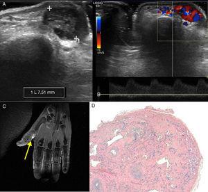 A. Imagen de ecografía en modo B en la que se observa una lesión de 7’5 mm en las partes blandas de la vertiente medial del primer dedo de la mano. B. Imagen de ecografía Doppler espectral en la que se observa un patrón arterial de baja resistencia. C. Imagen de RM potenciada en T2 con saturación grasa, la lesión es hiperintensa (flecha). D. En el análisis anatomopatológico la tinción hematoxilina eosina mostró numerosos espacios vasculares revestidos por un endotelio sin atipias sobre un estroma con papilas hialinizadas.