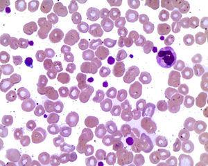 Frotis de sangre periférica con macrotrombocitos, estomatocitos y esquistocitos.