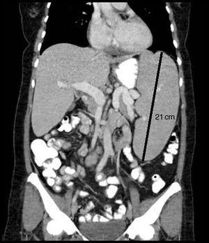 Tomografía axial computarizada de abdomen. Se observa esplenomegalia masiva, de 21cm de diámetro máximo.