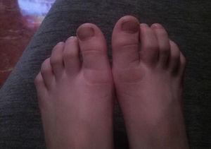 Fase de eritema en ambos pies.