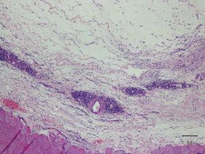 Engrosamiento y edema de la fascia muscular, con presencia de infiltrado inflamatorio linfocitario difuso y perivascular.