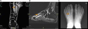 A) RM corte coronal, en saturación grasa, donde se aprecia edema óseo en diáfisis del segundo metatarsiano del pie izquierdo, y en partes blandas alrededor del mismo. B) RM corte sagital del pie izquierdo, secuencia STIR mostrando edema óseo en diáfisis del segundo metatarsiano y en partes blandas alrededor del mismo. C) Radiología simple mostrando imagen de callo de fractura en la diáfisis del segundo metatarsiano del pie izquierdo.
