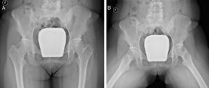 Anteroposterior (Panel A) and frog-leg lateral (Panel B) radiographs of the pelvis showing normal left hip joint space with discrete acetabular sclerosis.