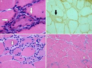 Imagen de la biopsia muscular: A) Se observan fibras musculares con áreas basófilas periféricas regenerativas (tinción hematoxilina-eosina ×63). B) Expresión muscular de los antígenos de clase I del sistema HLA. C) Se observa un infiltrado linfocitario endomisial (tinción hematoxilina-eosina ×40). D) Variabilidad del tamaño de fibras musculares e infiltrado inflamatorio periendomisial (tinción hematoxilina-eosina ×10).