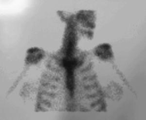 Gammagrafía ósea con captación esternoclavicular típica “en cabeza de toro”, compatible con síndrome de SAPHO.