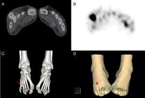 SPECT/TC tras la administración iv de leucocitos autólogos marcados con 20mCi de 99mTc-HMPAO. Imagen de fusión SPECT/TC (A) e imagen SPECT (B) en las que se observa depósito patológico de captación a nivel del 4.° metatarsiano del pie derecho. Reconstrucción 3D con ventana ósea (C) que permite correlación del hallazgo gammagráfico con la presencia de cuerpo extraño (flecha) que impronta sobre la superficie de la piel (D).