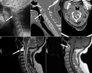 Radiografía lateral de columna cervical (A) en la que se observa una lesión osteolítica expansiva en el cuerpo vertebral de C2 con insuflación de la cortical (flecha). Cortes sagital (B) y axial (C) de la TC de columna cervical en la que se evidencia que dicha lesión reemplaza globalmente la médula ósea (flecha) y rompe la cortical en la superficie posterolateral derecha del cuerpo vertebral (flecha). Cortes sagitales en las secuencias potenciadas en T2 (D) y T1-posgadolinio (E) de la RM de columna cervical que muestra una zona quística, necrosis y trabeculación. La lesión es marcadamente hiperintensa en T2 e hipointensa en T1, mostrando realce periférico tras la administración de gadolinio (flechas).