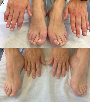 Hand and feet skin lesions at presentation (A) and after 10 months of treatment (B).