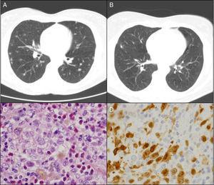 A) TAC pulmonar al momento del diagnóstico. B) TAC pulmonar a los 6 meses del abandono del hábito tabáquico. C) Células de Langerhans (hematoxilina-eosina). D) Técnica IHQ positiva para CD1a (×100).