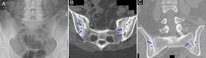 Radiografía de pelvis (A) que muestra esclerosis, pinzamiento y erosiones en articulación sacroilíaca derecha y esclerosis y seudo-ensanchamiento en la izquierda (sacroileítis grado III bilateral). TC de articulaciones sacroilíacas que en los cortes axial (B) y coronal (C) presentan zonas de esclerosis (asteriscos) y erosiones (flechas) en ambos márgenes articulares.