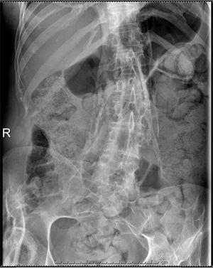 Radiografía de abdomen que muestra puentes óseos paravertebrales y en la cadera derecha.