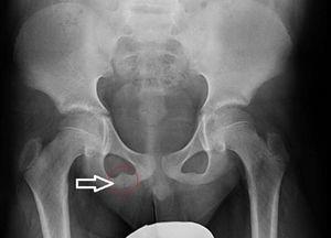 Radiografía AP de pelvis: engrosamiento de la sincrondrosis isquiopubiana derecha.