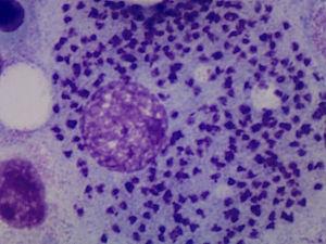 Células mononucleadas fagocitarias (macrófagos) que contiene abundantes inclusiones de formas parasitarias compatibles con leishmaniasis.