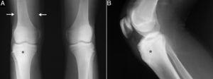 Radiografías anteroposterior de ambas rodillas (A) y lateral de la rodilla derecha (B), en las que se observa esclerosis del tercio superior de la tibia derecha (asteriscos) sin «nidus» aparente, y disminución de volumen de tercio distal del cuádriceps debido a atrofia muscular (flechas).