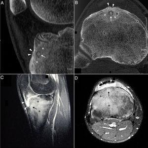Cortes sagital (A) y axial (B) de tomografía computarizada de la rodilla derecha, que evidencian una lesión osteolítica en la zona subendostal de la tuberosidad tibial anterior, con matriz osificada a modo de «nidus», compatible con osteoma osteoide (flecha), rodeada por importante esclerosis en el hueso medular circundante (asteriscos) y reacción perióstica sólida en la cortical adyacente (cabezas de flecha). En los cortes sagital (C) y axial (D) de la resonancia magnética en las secuencias T1-SPIR (Spectral Presaturation with Inversion Recovery) posgadolinium se observa captación de contraste perilesional en forma de anillo (flecha), así como en el edema óseo circundante (asteriscos) y la grasa de Hoffa (cabezas de flechas).