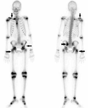Gammagrafía ósea que muestra múltiples zonas de captación (flechas).