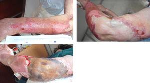 Evolution of skin lesions at first five days of internment: áreas of extensive skin detachment in the context of ruptura of blisters and severe exudation and necrotic áreas.