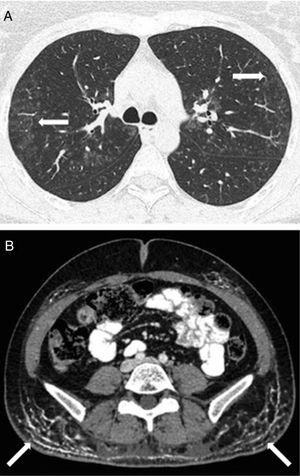 (A) A high resolution computed tomography image of both lungs showing a bilateral ground-glass pattern (arrows). (B) Extensive calcinosis cutis localized within the subcutaneous tissue of both buttocks (arrows) in an abdominal computed tomography image.