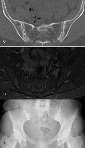 A) Radiografía anteroposterior de pelvis en la que se observa calcificación del fibrocartílago de la sínfisis púbica, así como esclerosis en ambas sacroilíacas con irregularidad en la cortical; B) Corte axial de resonancia magnética de pelvis. Secuencia STIR, donde se observa hiperseñal en ambas articulaciones sacroilíacas; C) Tomografía computarizada, corte axial, de pelvis, donde se observa fenómeno de vacío en sacroilíaca derecha, así como calcificación interna en el fibrocartílago de ambas articulaciones sacroilíacas, con osteofitos.