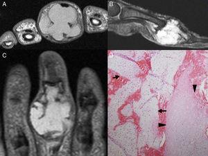 A-C) Imágenes de RMN; lesión expansiva multilobulada que muestra festoneado endóstico y adelgazamiento cortical importante, hipointensa en T1 (corte axial) e hiperintensa en secuencia potenciada en T2 con supresión grasa (corte sagital) y en secuencia STIR (corte coronal). D) Biopsia de la tumoración en la que se visualiza cartílago maduro hialino (flechas), con áreas de degeneración mixoide (cabezas de flechas), compatible con encondroma.