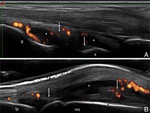 A) Carpo. Corte longitudinal dorsal. Distensión capsular a nivel de los recesos articulares radiocarpiano e intercarpiano, ambos con áreas de líquido sinovial (*) y áreas de proliferación sinovial (flecha), con incremento de la vascularización por Doppler de poder (grado 2). B) Articulación metacarpofalángica. Corte longitudinal dorsal. Distensión de la capsula articular con áreas de líquido sinovial (*) y áreas de proliferación sinovial (flecha), con incremento de la vascularización por Doppler de poder (grado 2). fp: falange proximal; g: grande; mc: metacarpiano; r: radio; s: semilunar.