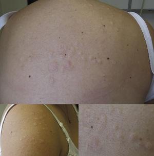 Pápulas y placas de color piel localizadas en la espalda y el hombro derecho, de apariencia laxa.