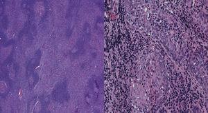Biopsy of extranodal marginal zone lymphoma of mucosa-associated lymphoid tissue of the parotid gland in case 2. Left image shows Hematoxylin & Eosin (H&E) stain in low-power view. Right image shows H&E stain in high-power view.