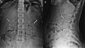 A) Radiografía anteroposterior del abdomen. Se observan imágenes radiopacas de densidad calcio que engloban a ambas siluetas renales (flechas blancas). B) Radiografía lateral del abdomen donde se muestran dichas calcificaciones, desde las vértebras L2 a L4 (flecha blanca).