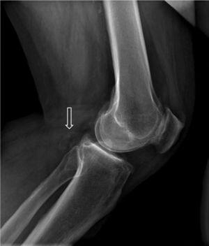 Rx lateral de rodilla: lesión ósea exofítica (flecha) dependiente de la tibia correspondiente a un osteocondroma epifisario.