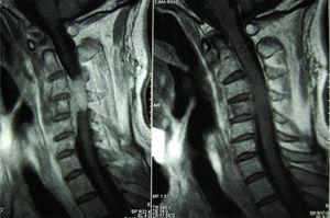 Resonancia magnética de columna cervical que muestra el compromiso vertebral C4 y extensión a canal medular.