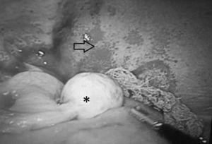 Laparotomía exploradora que muestra ovario izquierdo de características normales (*), sin características macroscópicas de tumor, asas intestinales edematosas y peritoneo con fragilidad capilar (flecha).