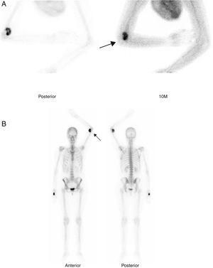 Gammagrafía ósea en 2 fases tras la inyección de 814 MBq de 99mTc-hidroxi-difosfonato. Imágenes estáticas a los 10min (fase tisular [A]) y cuerpo completo a las 2h (fase ósea [B]), en las que se observa captación heterogénea del radiotrazador en región anterior del codo izquierdo (flechas).