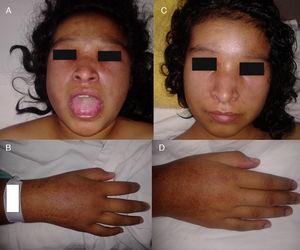a) Edema facial y macroglosia. B) Edema de mano. C, D) Edema facial y de mano, 15 días después del inicio de tratamiento.