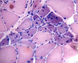 Biopsia de músculo: infiltrado inflamatorio, con atrofia y regeneración perifascicular.