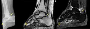 Lateral right ankle radiography (A), T1 weighted sequence (B) and sagittal STIR MRI sequence (C) images demonstrating an enlarged Stieda's process (arrows) with mild bone marrow and soft tissues edema.