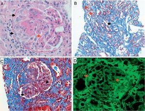 Biopsia renal. A) Coloración de hematoxilina eosina 40×; se observa patrón membranoproliferativo con imagen de doble contorno (flecha roja), formación de semilunas (flechas negras). B) Coloración tricrómica de Masson 10×; se observa nefritis tubulointersticial con infiltrado mononuclear (flechas rojas), fibrosis intersticial (flecha negra). C) Coloración tricrómica de Masson 40×; con presencia de trombos y necrosis fibrinoide en asas capilares (flechas negras), fibrosis glomerular segmentaria (flecha roja). D) Inmunofluorescencia 40×; positiva para inmunoglobulina G con patrón granular focal y solo algunos segmentos de asas capilares (flechas rojas).