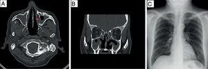 A,B) TAC de senos paranasales en fase simple: corte axial (A), corte coronal (B), con engrosamiento mucoso nasosinusal, erosión ósea leve que involucra pared de antro maxilar izquierdo (flecha roja) y cornetes inferiores. C) Radiografía de tórax posteroanterior normal, parénquima pulmonar sin lesiones.