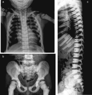 Las radiografías de tórax (a) y pelvis (b) demuestran un aumento difuso y homogéneo de la densidad ósea, más evidente en arcos costales y huesos pélvicos, así como mala diferenciación córtico-medular y ensanchamiento de las metáfisis de huesos largos. En la proyección lateral de columna (c), se evidencia esclerosis de los platos superiores e inferiores de los cuerpos vertebrales, imagen denominada «vértebra sándwich».