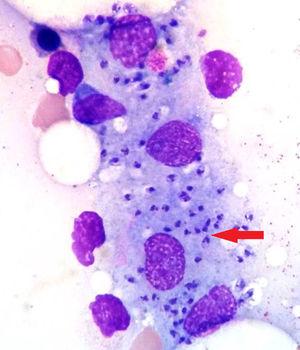 Biopsia de médula ósea: se observan varios macrófagos con amastigotes de Leishmania en su interior (flecha).
