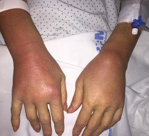 Artritis de ambos carpos con tenosinovitis.