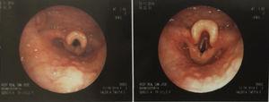 Endoscopia donde se observa estructuras laríngeas edematosas multinodulares.