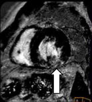 CRM que muestra afectación parcheada intramiocárdica (la flecha indica una de las zonas miocárdicas más afectadas).