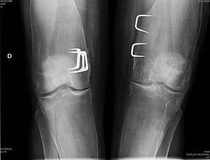 Imagen característica de las rodillas, con material quirúrgico de la intervención infantil por genu valgo y la morfología característica en «matraz de Erlenmeyer» del fémur distal.