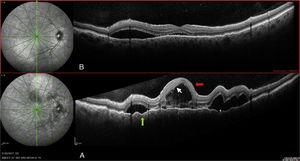 Ojo derecho: A) Al diagnóstico. B) Siete días tras el diagnóstico. Desprendimiento seroso > 450 (flecha gris) tabicado (asterisco). Puntos hiperreflectivos (flecha blanca). Pliegues del epitelio pigmentario de la retina (punta de flecha negra).