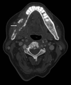 Extensa área de osteonecrosis en región hemimandibular derecha (flecha blanca).